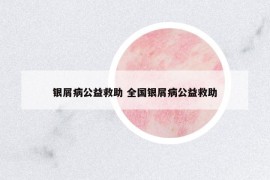銀屑病公益救助 全國(guó)銀屑病公益救助