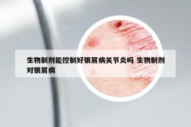 生物制劑能控制好銀屑病關(guān)節(jié)炎嗎 生物制劑對(duì)銀屑病