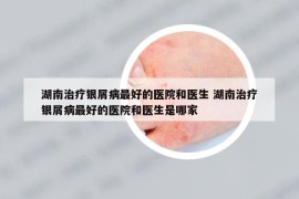 湖南治療銀屑病最好的醫(yī)院和醫(yī)生 湖南治療銀屑病最好的醫(yī)院和醫(yī)生是哪家