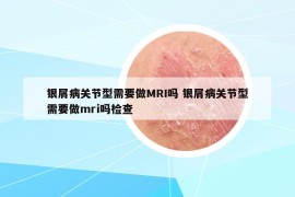 銀屑病關(guān)節(jié)型需要做MRI嗎 銀屑病關(guān)節(jié)型需要做mri嗎檢查