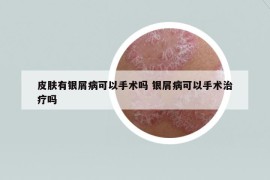 皮膚有銀屑病可以手術(shù)嗎 銀屑病可以手術(shù)治療嗎
