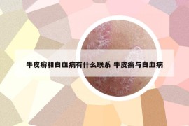 牛皮癬和白血病有什么聯(lián)系 牛皮癬與白血病