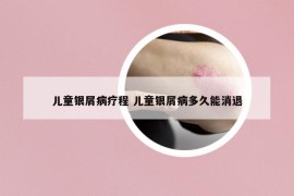 兒童銀屑病療程 兒童銀屑病多久能消退
