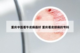 重慶中醫(yī)看牛皮癬最好 重慶看皮膚癬的?？? /></a>		
		</figure>

		<header class=