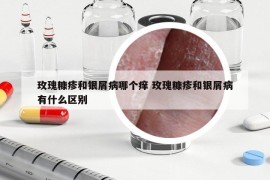 玫瑰糠疹和銀屑病哪個(gè)癢 玫瑰糠疹和銀屑病有什么區(qū)別