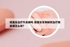 修美樂(lè)治療牛皮癬嗎 修美樂(lè)生物制劑治療銀屑病怎么樣?
