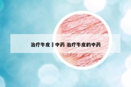 治療牛皮廯中藥 治療牛皮的中藥