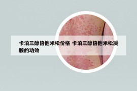 卡泊三醇倍他米松價格 卡泊三醇倍他米松凝膠的功效