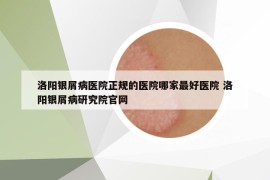 洛陽(yáng)銀屑病醫(yī)院正規(guī)的醫(yī)院哪家最好醫(yī)院 洛陽(yáng)銀屑病研究院官網(wǎng)