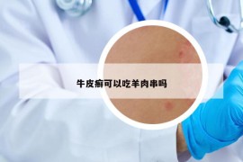 牛皮癬可以吃羊肉串嗎