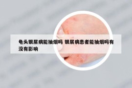 龜頭銀屑病能抽煙嗎 銀屑病患者能抽煙嗎有沒有影響