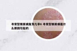 尋常型銀屑病復(fù)發(fā)幾率6 尋常型銀屑病是什么原因引起的