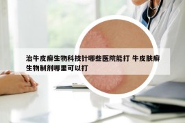 治牛皮癬生物科技針哪些醫(yī)院能打 牛皮膚癬生物制劑哪里可以打
