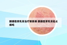 酮康他索乳膏治療銀屑病 酮康他索乳膏能止癢嗎