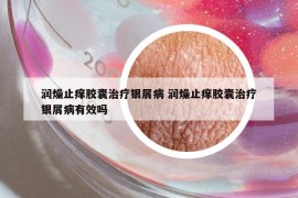 潤(rùn)燥止癢膠囊治療銀屑病 潤(rùn)燥止癢膠囊治療銀屑病有效嗎
