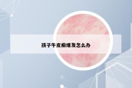 孩子牛皮癬爆發(fā)怎么辦
