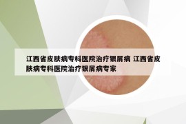 江西省皮膚病?？漆t(yī)院治療銀屑病 江西省皮膚病?？漆t(yī)院治療銀屑病專家