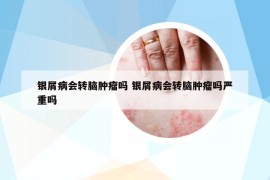 銀屑病會(huì)轉(zhuǎn)腦腫瘤嗎 銀屑病會(huì)轉(zhuǎn)腦腫瘤嗎嚴(yán)重嗎