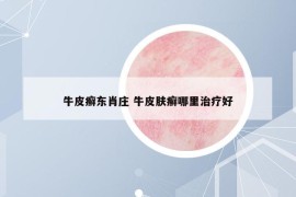 牛皮癬東肖莊 牛皮膚癬哪里治療好
