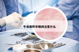 牛皮癬懷孕期間注意什么
