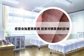 感冒會(huì)加重銀屑病 感冒對(duì)銀屑病的影響