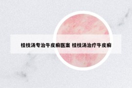 桂枝湯專治牛皮癬醫(yī)案 桂枝湯治療牛皮癬