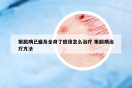 銀翹病已遍及全身了應(yīng)該怎么治療 銀翹病治療方法