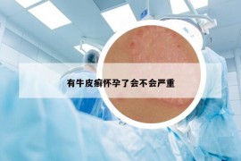 有牛皮癬懷孕了會不會嚴(yán)重