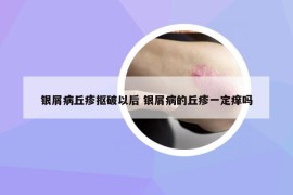銀屑病丘疹摳破以后 銀屑病的丘疹一定癢嗎