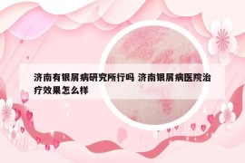 濟(jì)南有銀屑病研究所行嗎 濟(jì)南銀屑病醫(yī)院治療效果怎么樣