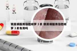 銀屑病服用倍他胡蘿卜素 銀屑病服用倍他胡蘿卜素有用嗎