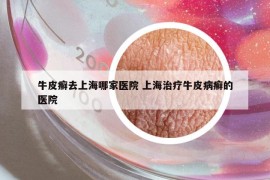牛皮癬去上海哪家醫(yī)院 上海治療牛皮病癬的醫(yī)院