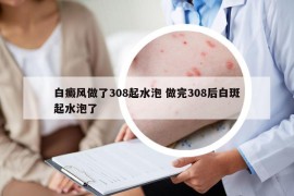 白癜風(fēng)做了308起水泡 做完308后白斑起水泡了