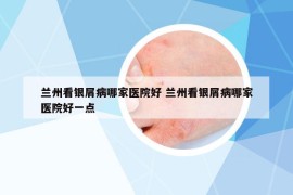 蘭州看銀屑病哪家醫(yī)院好 蘭州看銀屑病哪家醫(yī)院好一點(diǎn)
