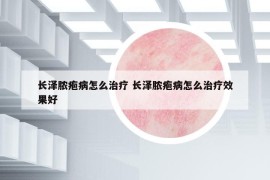 長(zhǎng)澤膿皰病怎么治療 長(zhǎng)澤膿皰病怎么治療效果好