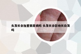 頭發(fā)長會(huì)加重銀屑病嗎 頭發(fā)長會(huì)影響長白發(fā)嗎