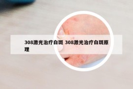 308激光治療白斑 308激光治療白斑原理