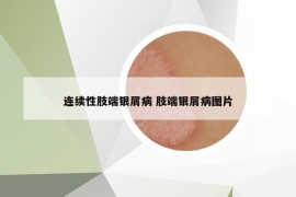 連續(xù)性肢端銀屑病 肢端銀屑病圖片