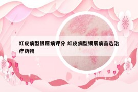 紅皮病型銀屑病評分 紅皮病型銀屑病首選治療藥物