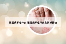 銀屑病不吃什么 銀屑病不吃什么食物好得快
