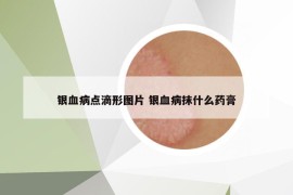 銀血病點滴形圖片 銀血病抹什么藥膏