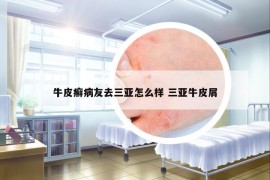 牛皮癬病友去三亞怎么樣 三亞牛皮屑