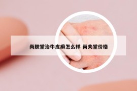 尚膚堂治牛皮癬怎么樣 尚夫堂價格