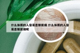 什么體質的人容易患銀屑病 什么體質的人容易患銀屑病呢