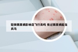 輕微銀屑病影響召飛行員嗎 有過銀屑病能當(dāng)兵馬