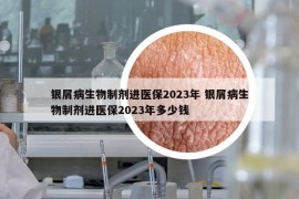 銀屑病生物制劑進醫(yī)保2023年 銀屑病生物制劑進醫(yī)保2023年多少錢
