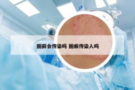 圈蘚會(huì)傳染嗎 圈癬傳染人嗎