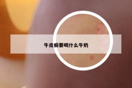 牛皮癬要喝什么牛奶