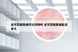 關(guān)節(jié)型銀屑病可以評殘嗎 關(guān)節(jié)型銀屑病能活多久