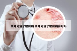 紫外光冶了銀屑病 紫外光冶了銀屑病會好嗎